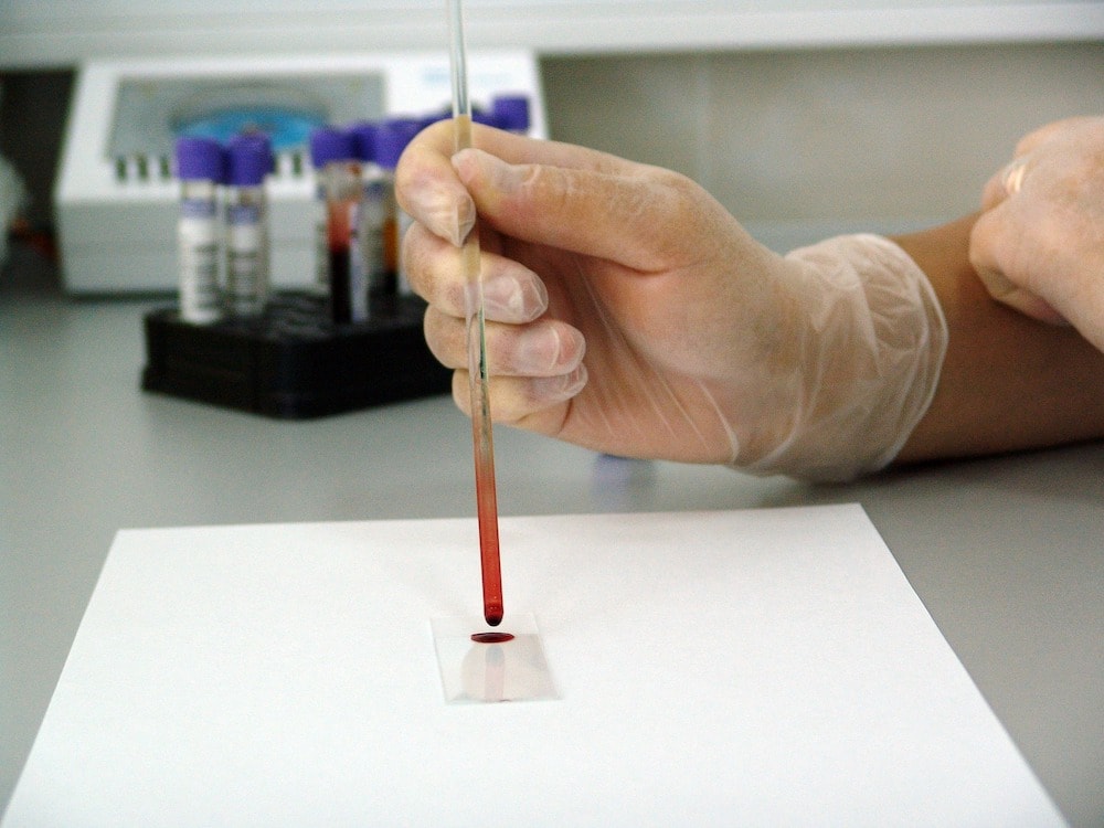 Tumor infiltrating immune cells predict patient outcomes