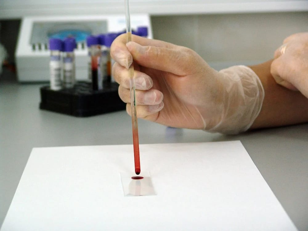Tumor infiltrating immune cells predict patient outcomes