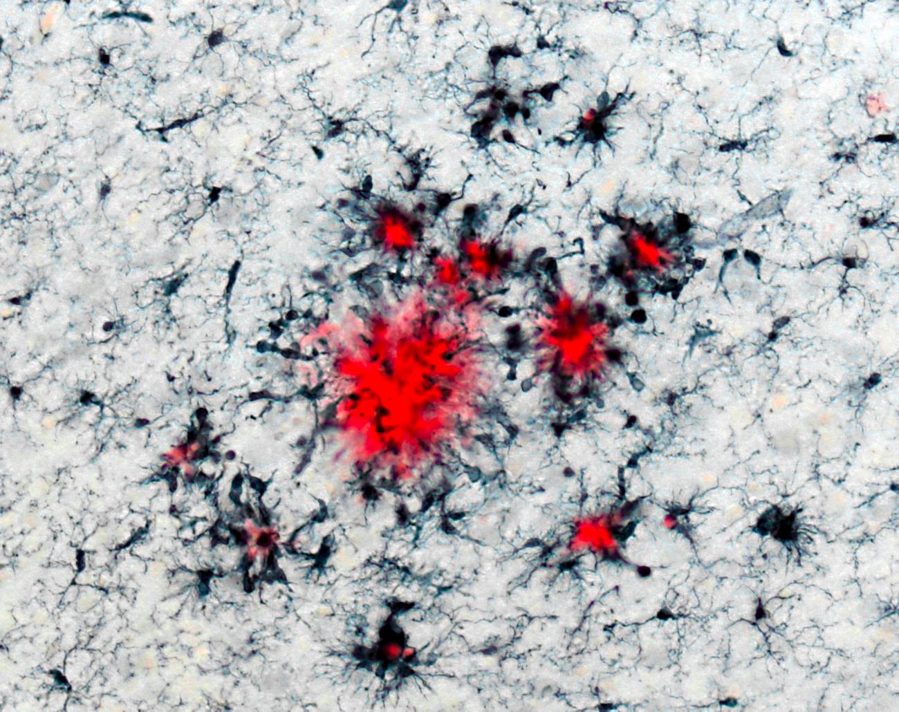 Microglia (black) accumulating around amyloid-β depositions (red) in the brain.